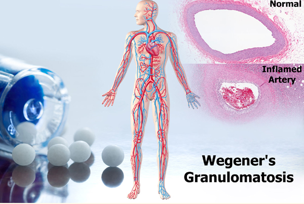 Wegener's Granulomatosis
