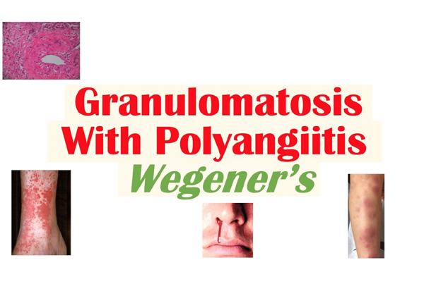 Granulomatosis with Polyangiitis
