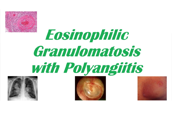 Eosinophilic Granulomatosis with Polyangiitis