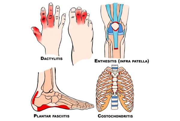Spondyloarthritis