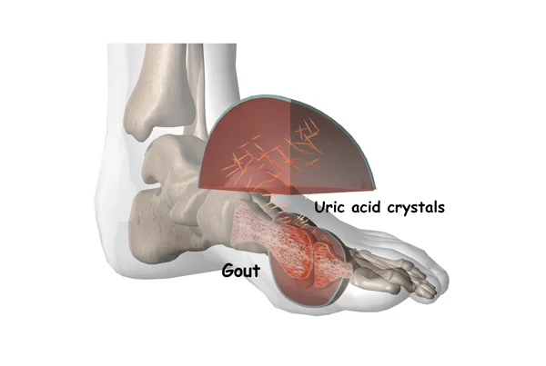 Gout / Uric Acid