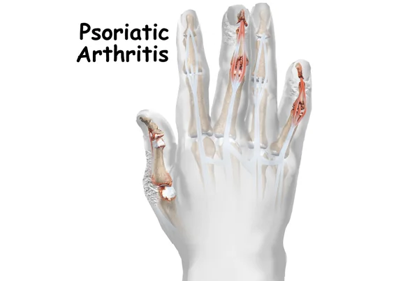 Psoriatic Arthritis