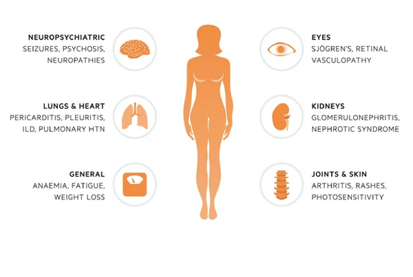 Systemic Lupus Erythematosus (SLE)