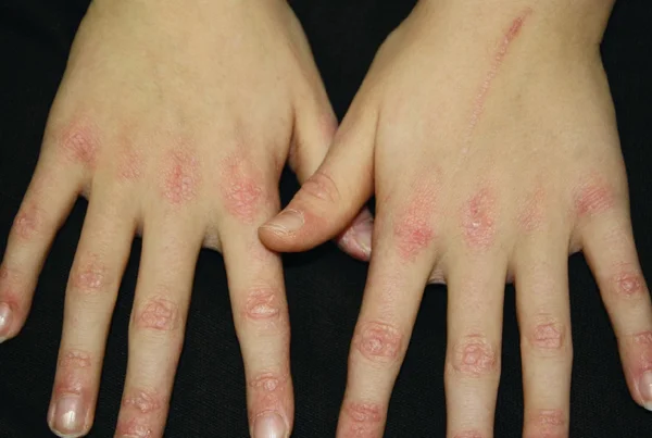 Dermatomyositis