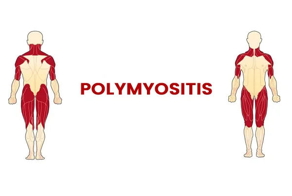 Polymyositis